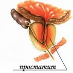 Простатит